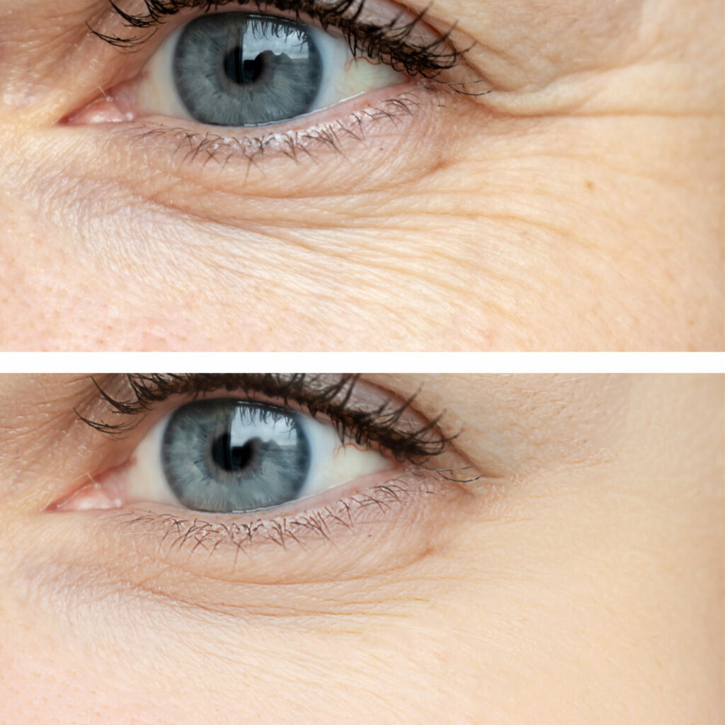 Before and after of eyes post anti-wrinkle treatment